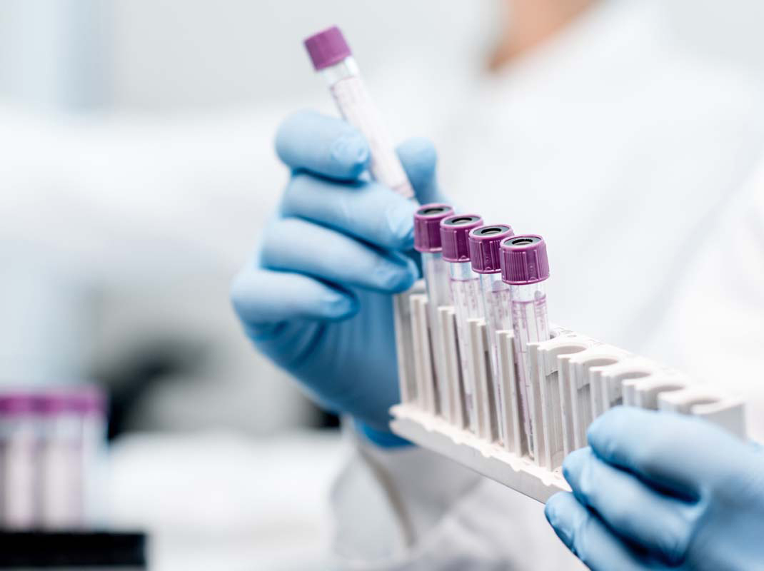 What Role Do Liquid Biopsies Play in the Treatment of NSCLC