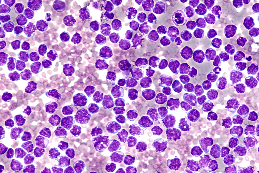clinical presentation of mantle cell lymphoma