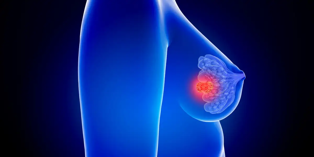 Treating Triple-Negative Breast Cancer