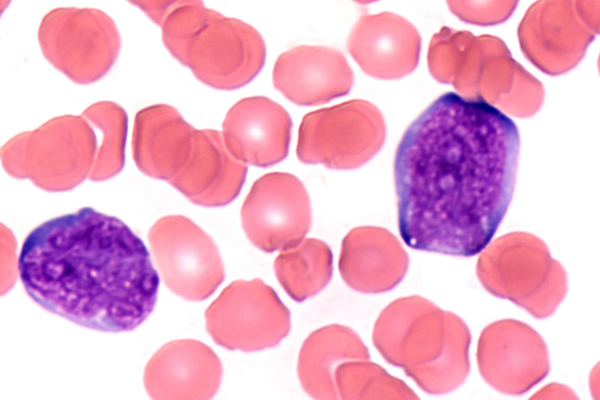 blast peripheral blood