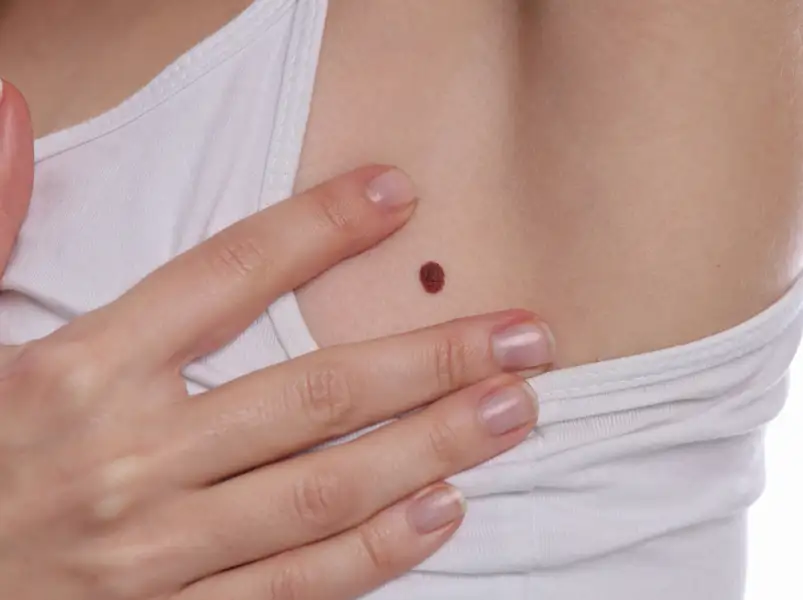 I have these brown circle patches of dry skin under my breasts