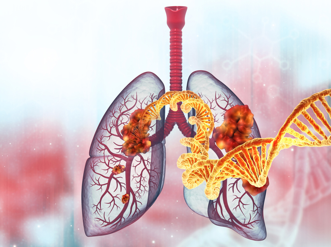 Immunotherapy for Lung Cancer Brings Treatment Breakthroughs
