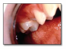 Photo showing the caries process