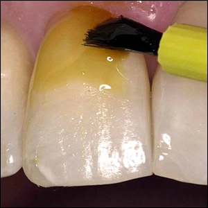 Image showing application of a sodium fluoride varnish