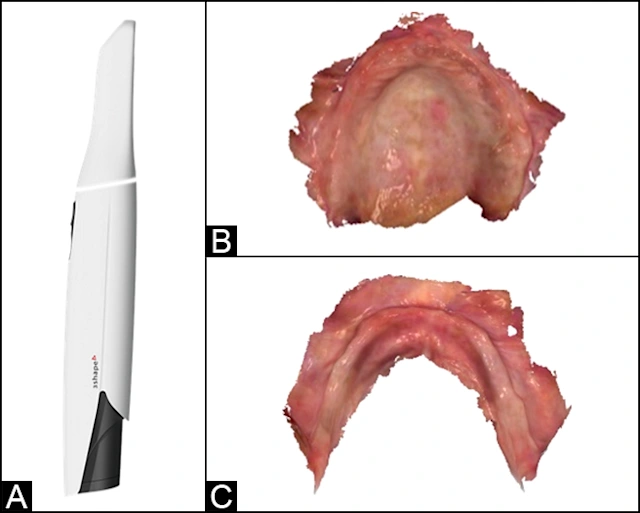 Use of Intraoral Scanners in Digital Denture Fabrication | Digital ...