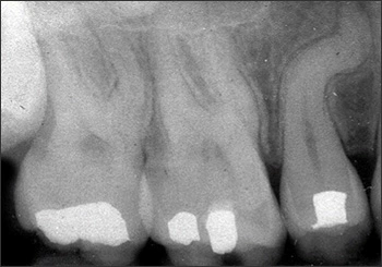 mPeriapical radiograph of root dilaceration of #4