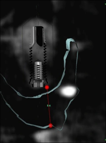 Photo showing a CBCT cross sectional image with the vertical restorative space being calculated.