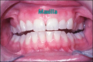 img22-maxilla