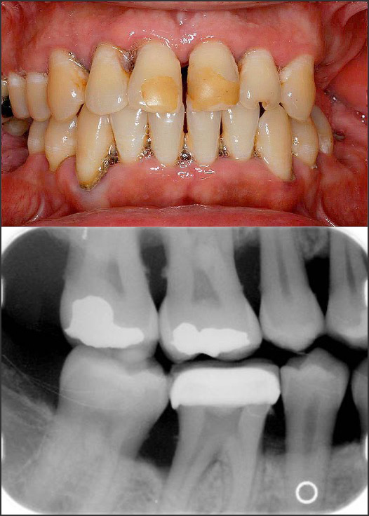 Steps For Determining A Diagnosis Of Periodontitis - The 2018 AAP/EFP ...