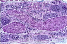fig06-tumor-cells