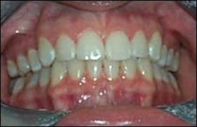  ce337 - Content - Attached Gingiva - Figure 1