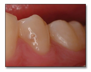 Photo showing an example of mandibular second premolar with a buccal surface cavitation that cannot be remineralized