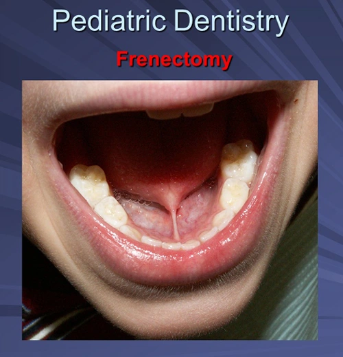 This image depicts a four-year-old male with significant ankyloglossia.