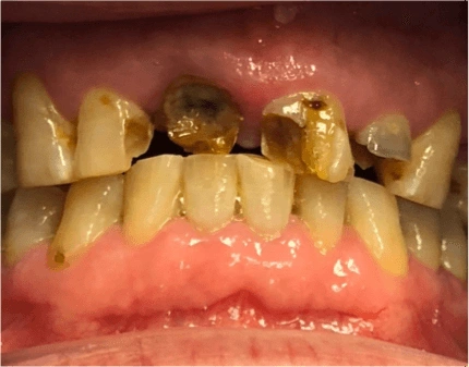 img09-dental-caries
