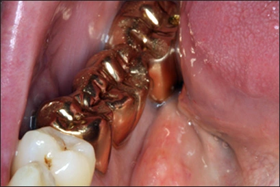 ce542 - Content - Crowns and Bridges - Figure 3