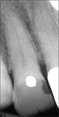 Conjoined Teeth - Figure 1