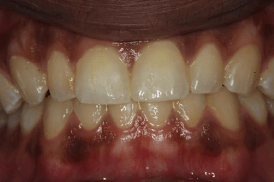 A representative depiction of the gingiva with despite subpar oral hygiene and visible plaque and doesn’t show overt gingivitis symptoms.