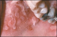 fig02-vesiculoerosive-lesion