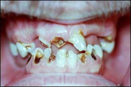 Image: Significant and rampant caries.