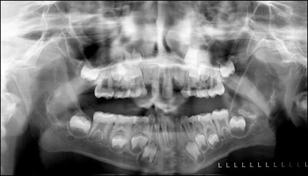 fig04-20mnth-pan-xray