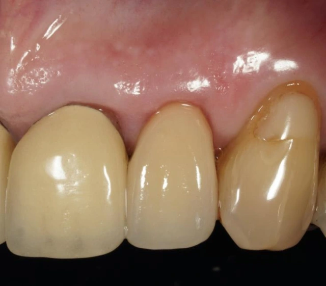 Types of Materials Used in Esthetic Restorations - Care & Maintenance ...