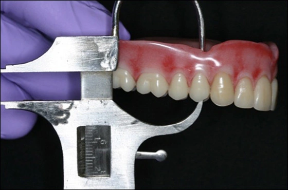 Photo showing vertical restorative space being measured with Boley gauge at right first premolar.