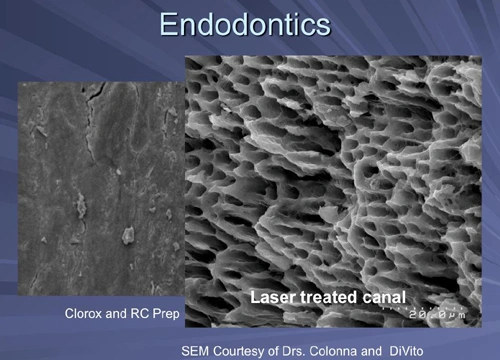 This image depicts a molar that was treated with PIPS only with no mechanical instrumentation and then sealed with EndoRez to demonstrate the effectiveness of the procedure.