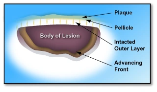 Diagram of an early tooth lesion