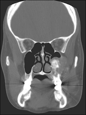 fig04-ct-scan-left-max