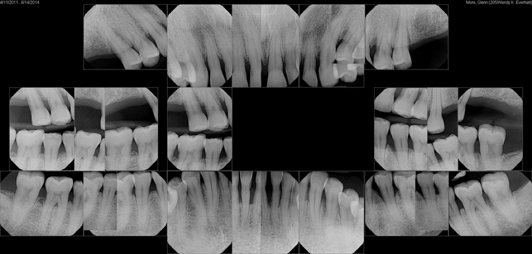 Photos showing bitewing x-rays