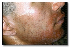 Image: Allergic contact dermatitis characterized by rash, redness, and itching, which began about 24 hours after dental treatment under a rubber dam.
