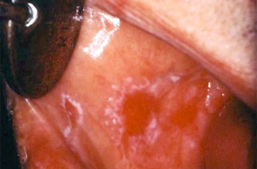 ce537 - Content - ADRs Affecting Skin (Mucosa) and Appendages - Figure 8