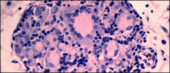 Case Challenge 30 - Content - Diagnostic Information - fig04-granuloma-high