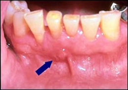 Image: Periapical abscess leading to parulis