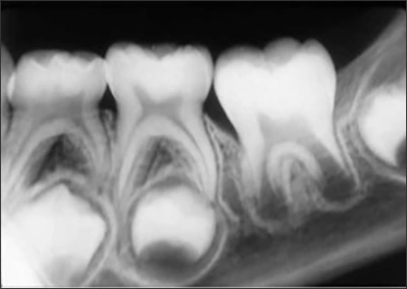 Normal Radiographic Appearance of Teeth - Figure 2