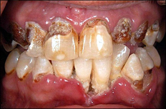 Image of METH mouth.