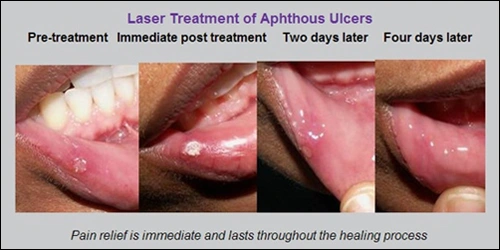This image depicts a series of four photos showing the healing process over four days of an aphthous stomatitis treated with combination therapy of Nd:YAG and Er:YAG biostimulation.