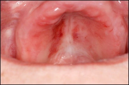 Image: Ecchymosis