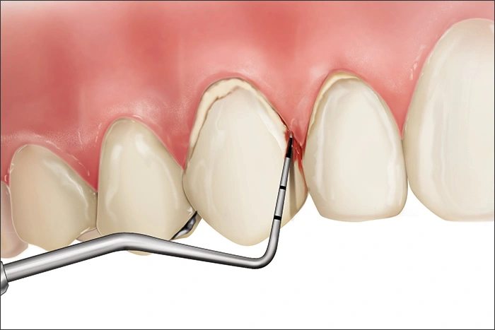 Illustration showing a Code 2 during periodontal probing