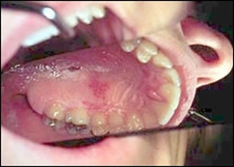 Image: Herpes zoster
