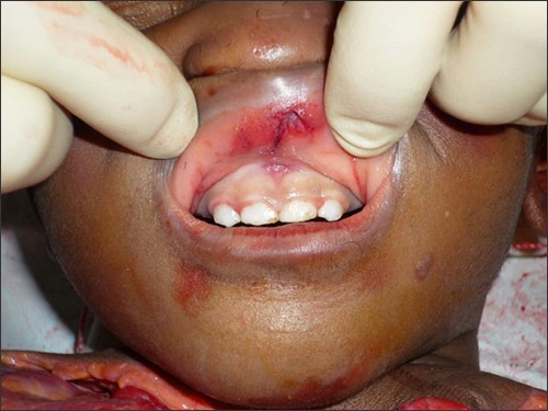 ce599 Photo showing child abuse homicide victim with torn labial frenum