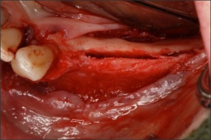 Modifying Existing Bone Volume - Figure 1