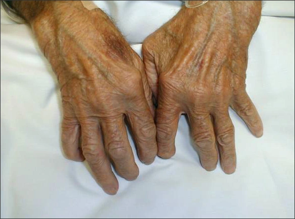 Hands of a patient with Rheumatoid Arthritis