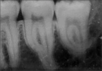 Periapical radiograph of root dilaceration #17 and #18