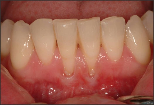 Photo showing gingival recession