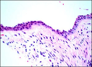  Case Challenge 28 - Content - Diagnostic Information - fig04-photomicrograph-med