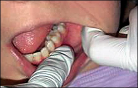 ce337 - Content - Attached Gingiva - Figure 2