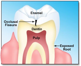 Diagram showing the surfaces at risk for root caries