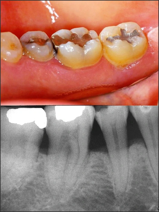 Photo and x-ray showing Stage 2 Grade B periodontitis