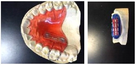Images showing human enamel specimens mounted into appliances worn for human in situ erosion prevention studies.